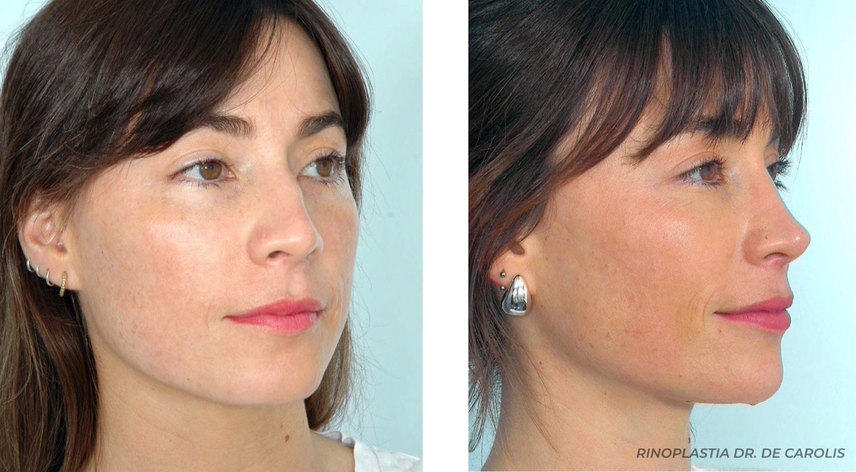 Rinoplastia terciaria con excelente resultado estético por el Dr. De Carolis. Vista de semiperfil.