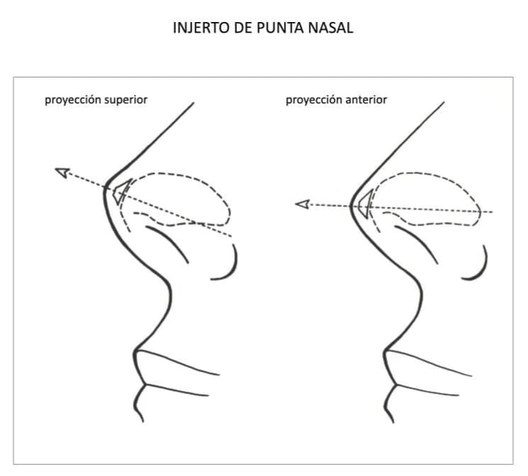 Ilustración de precisión de injertos de punta nasal para rinoplastia por el Dr. De Carolis