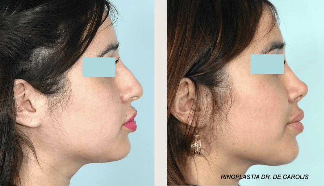 Rinoplastia con excelente resultado estético realizada por el Dr. De Carolis. Vista de perfil.