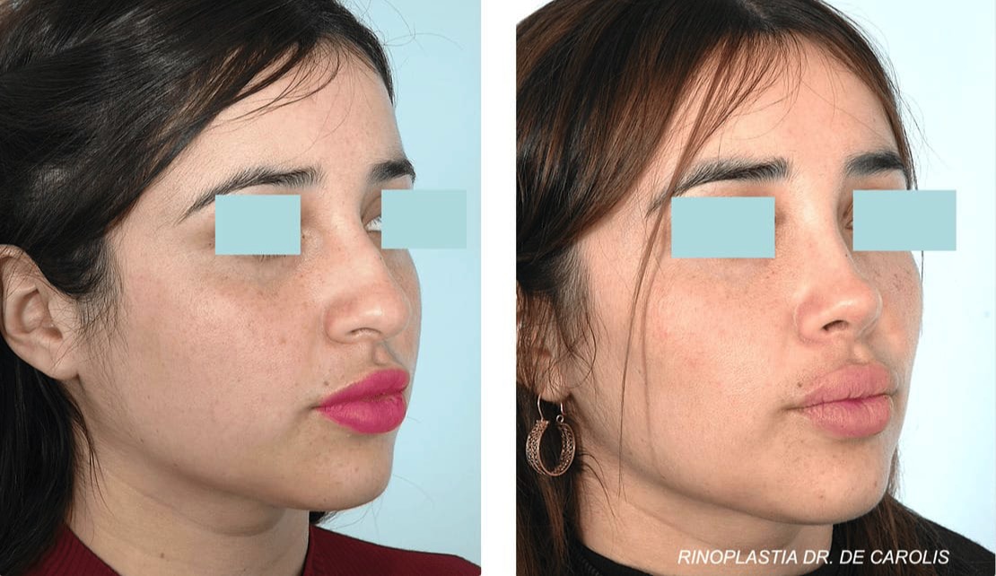 Rinoplastia con excelente resultado estético realizada por el Dr. De Carolis. Vista de perfil.