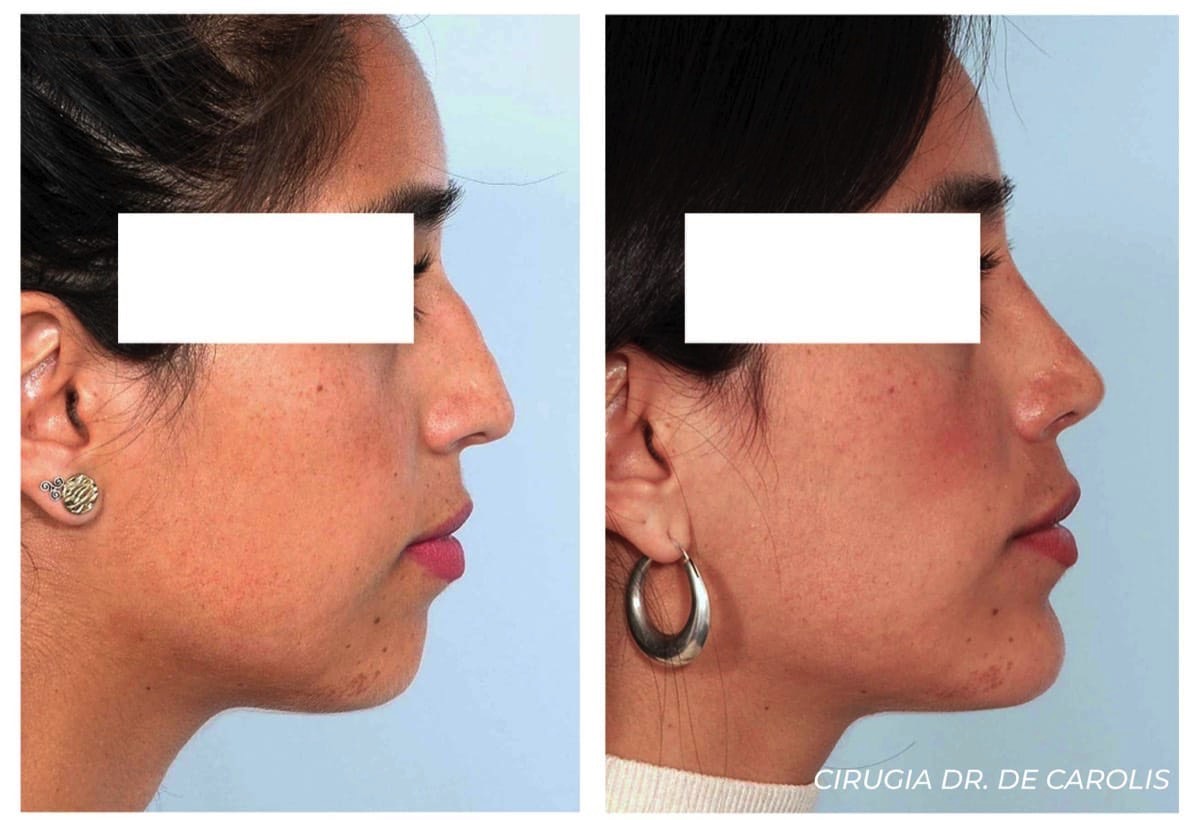 Rinoplastia y mentoplastia para mejorar el equilibrio facial, realizada por el Dr. De Carolis. Perfil.