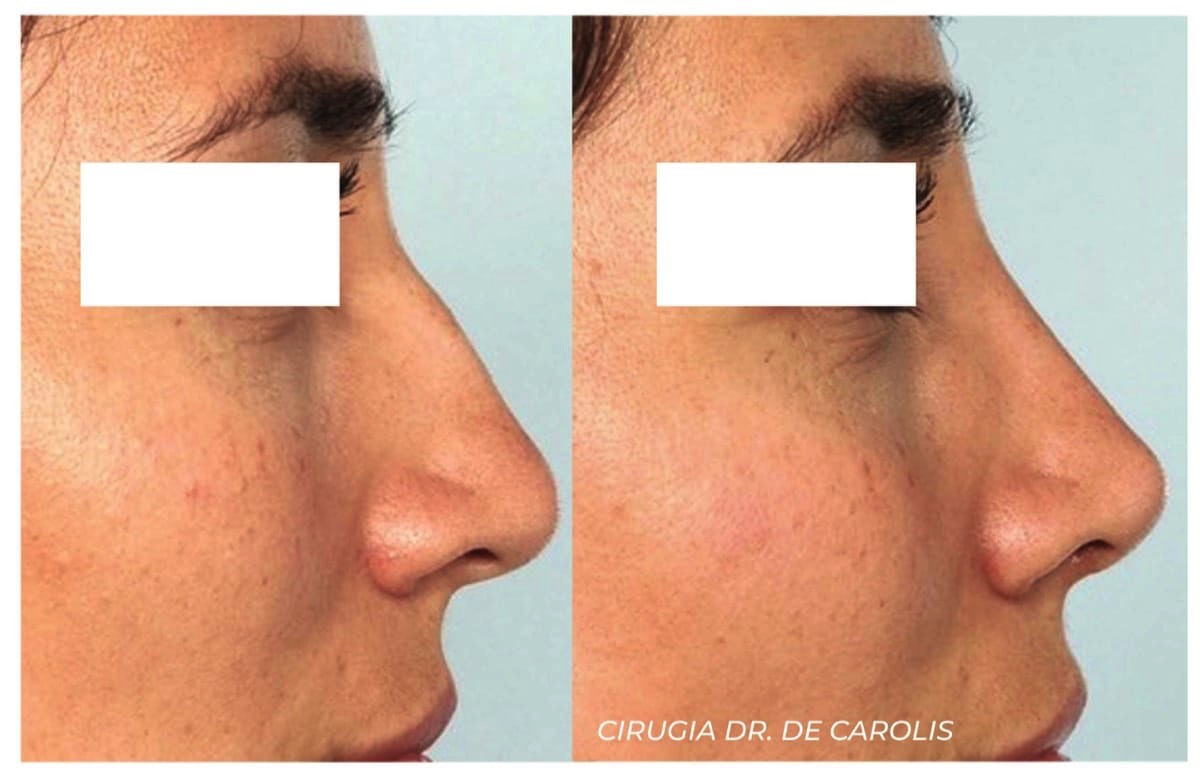 Rinoplastia con resultados naturales realizada por el Dr. De Carolis
