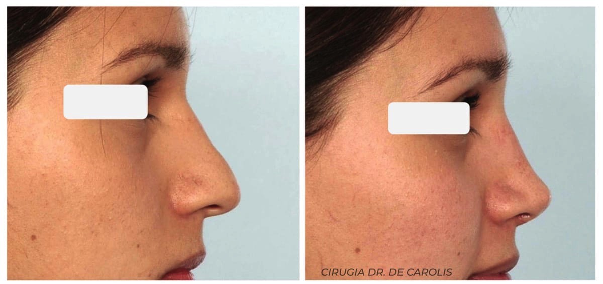 rinoplastia-punta-nasal-ancha-De-Carolis. Vista perfil.jpg