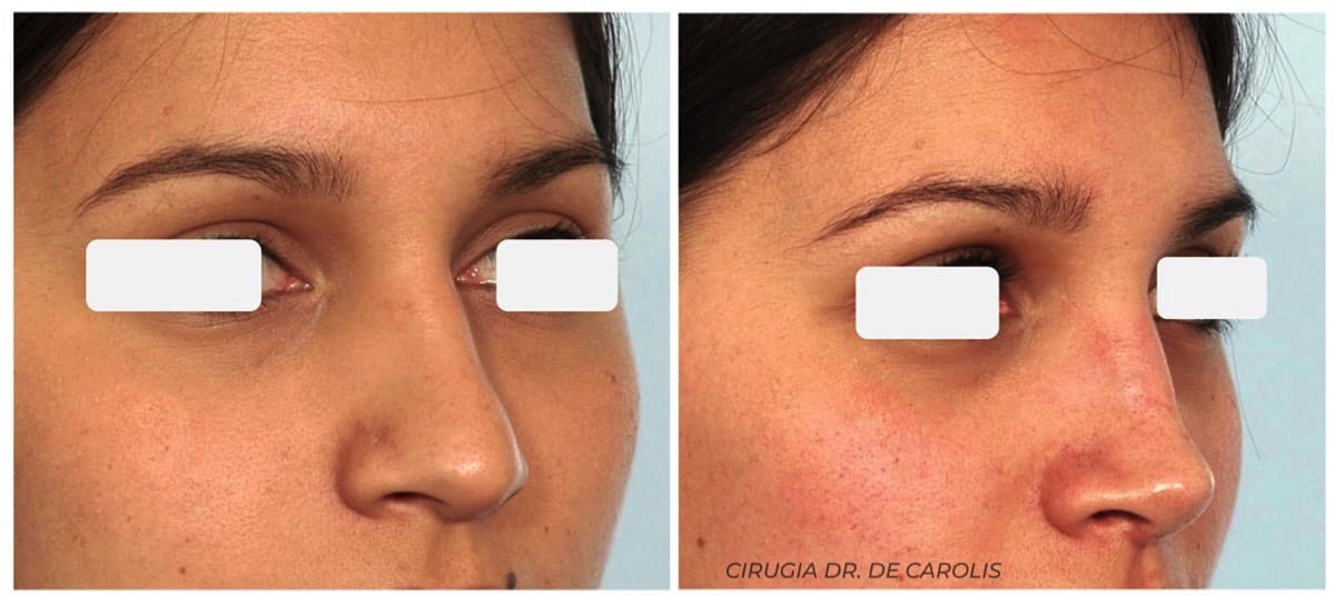 Rinoplastia en punta nasal ancha por el Dr.De Carolis. Vista semiperfil