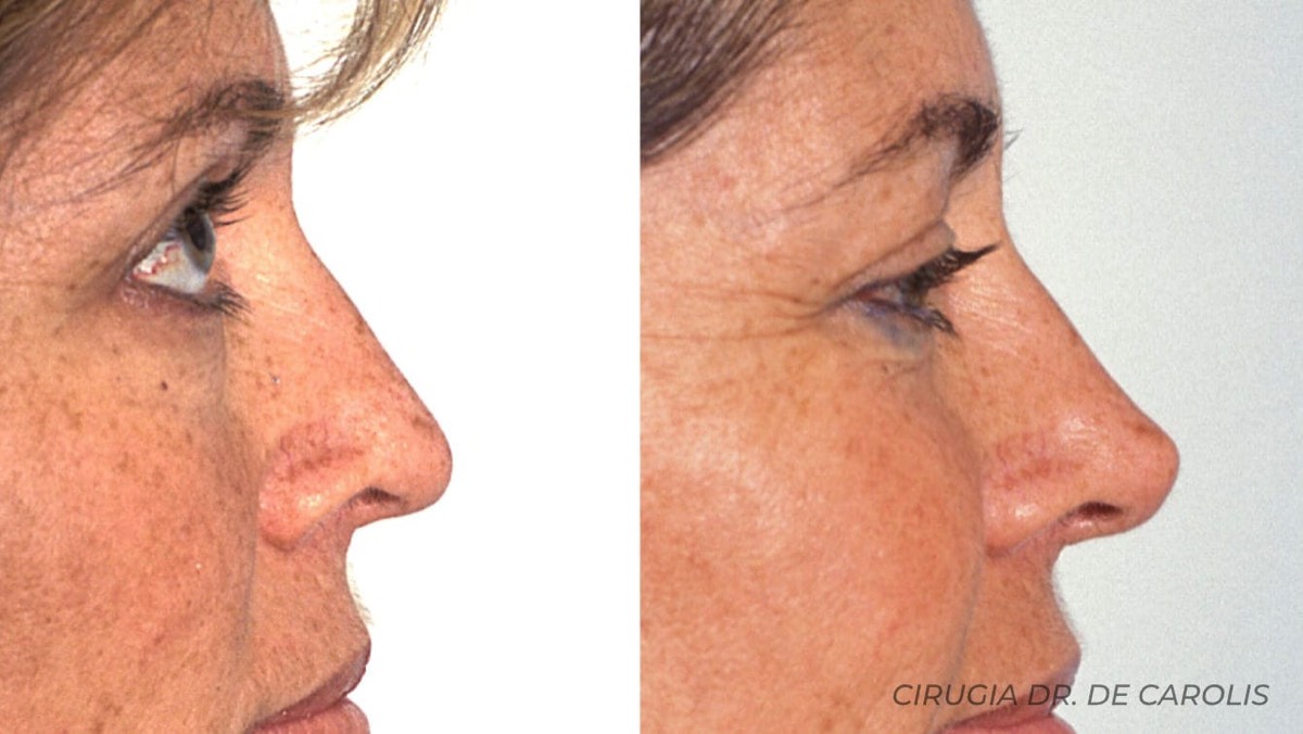 Close-up de una cirugía de la punta nasal por el Dr. De Carolis, destacando el refinamiento y la proyección obtenida.