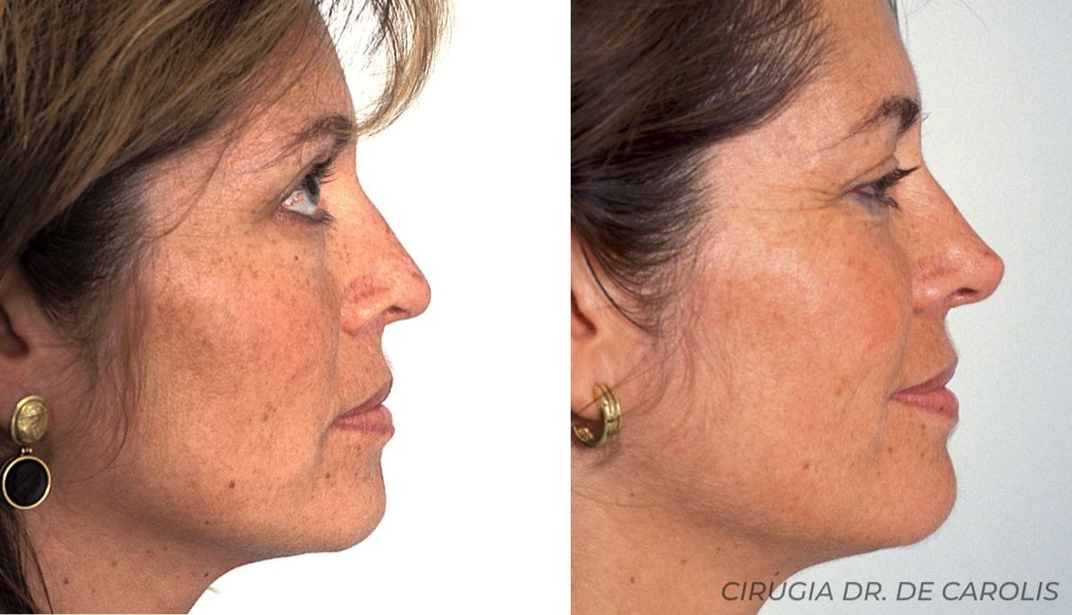 Rinoplastia limitada a la punta nasal, logrando una proyección armoniosa y natural.