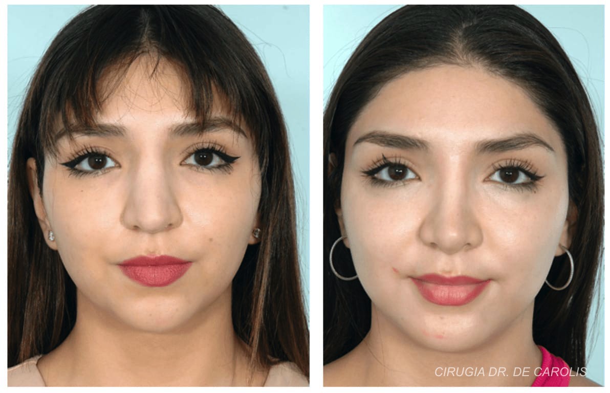 Rinoplastia secundaria tras un año, con resultado equilibrado y natural por el Dr. De Carolis. Frontal.