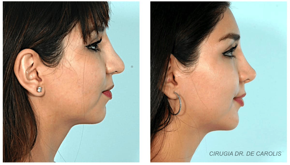 Rinoplastia secundaria después de un año, con resultado estético refinado por el Dr. De Carolis. Perfil.