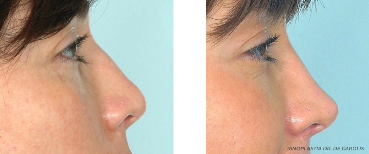 Close-up del resultado de una rinoplastia terciaria por el Dr. De Carolis, destacando el refinamiento y la armonía obtenida.