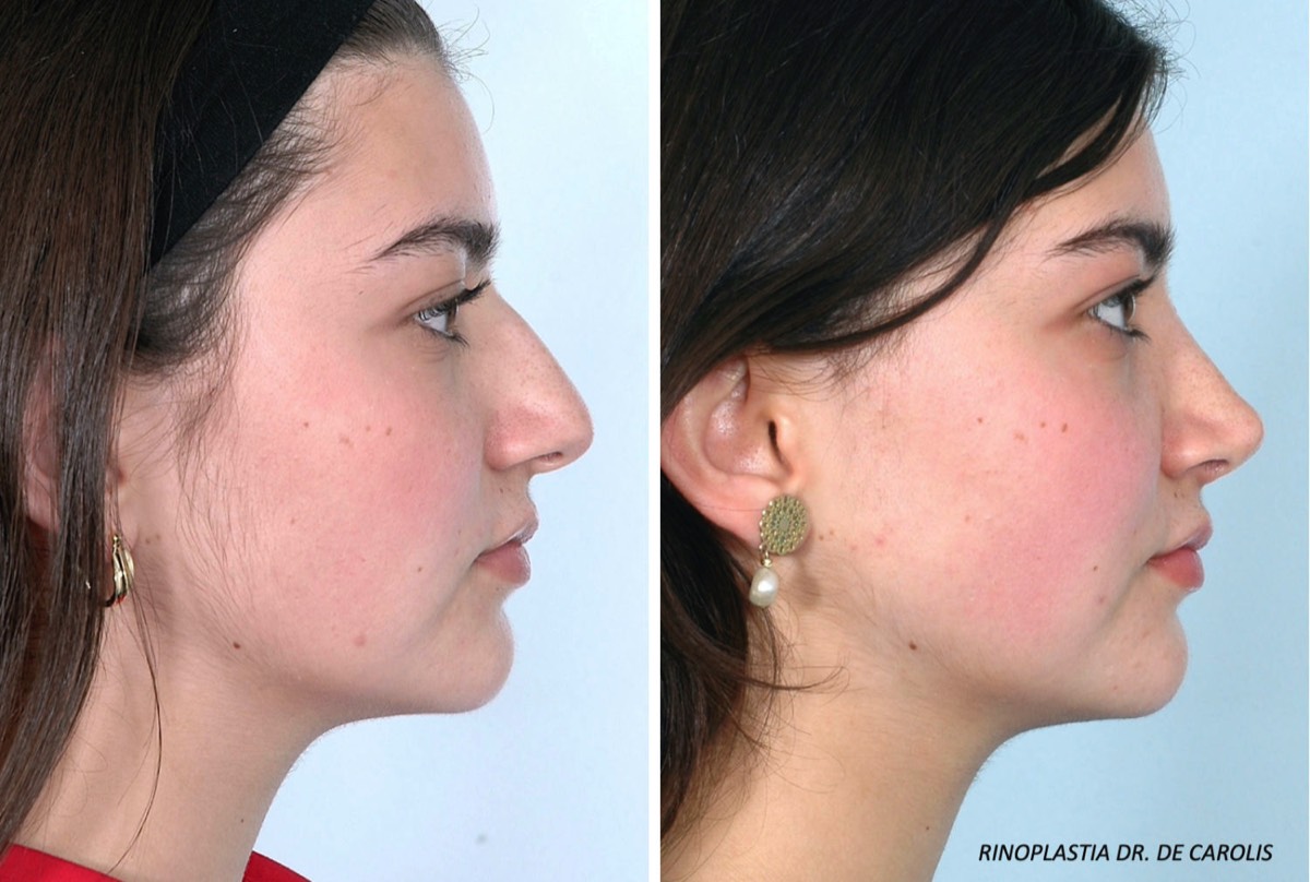 Rinoplastia ultrasónica combinada con técnica estructural de la punta nasal,  por el Dr. Vicente De Carolis. Vista perfil.