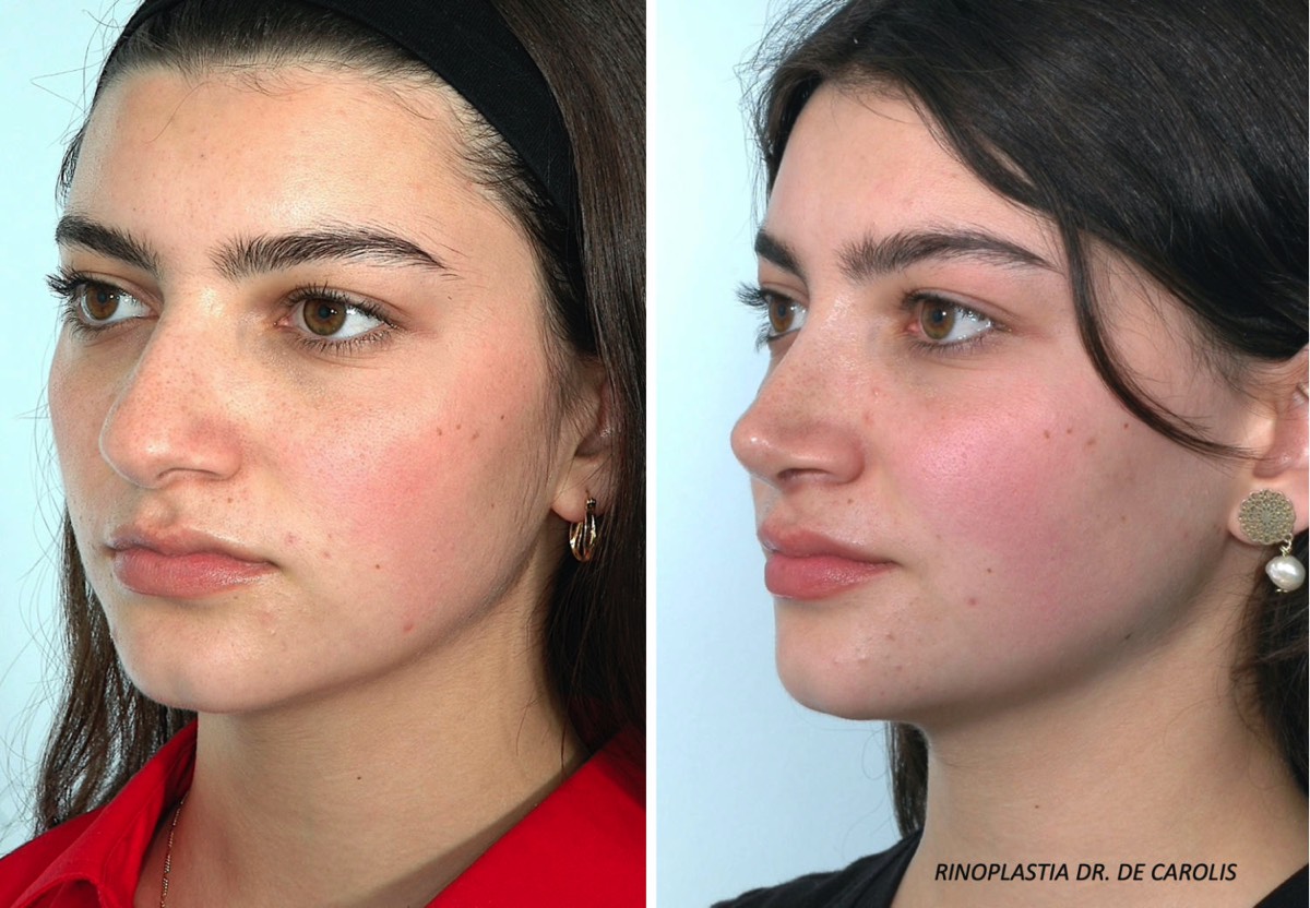 Rinoplastia ultrasónica con refinamiento estructural de la punta nasal por el Dr. Vicente De Carolis. Vista semiperfil.