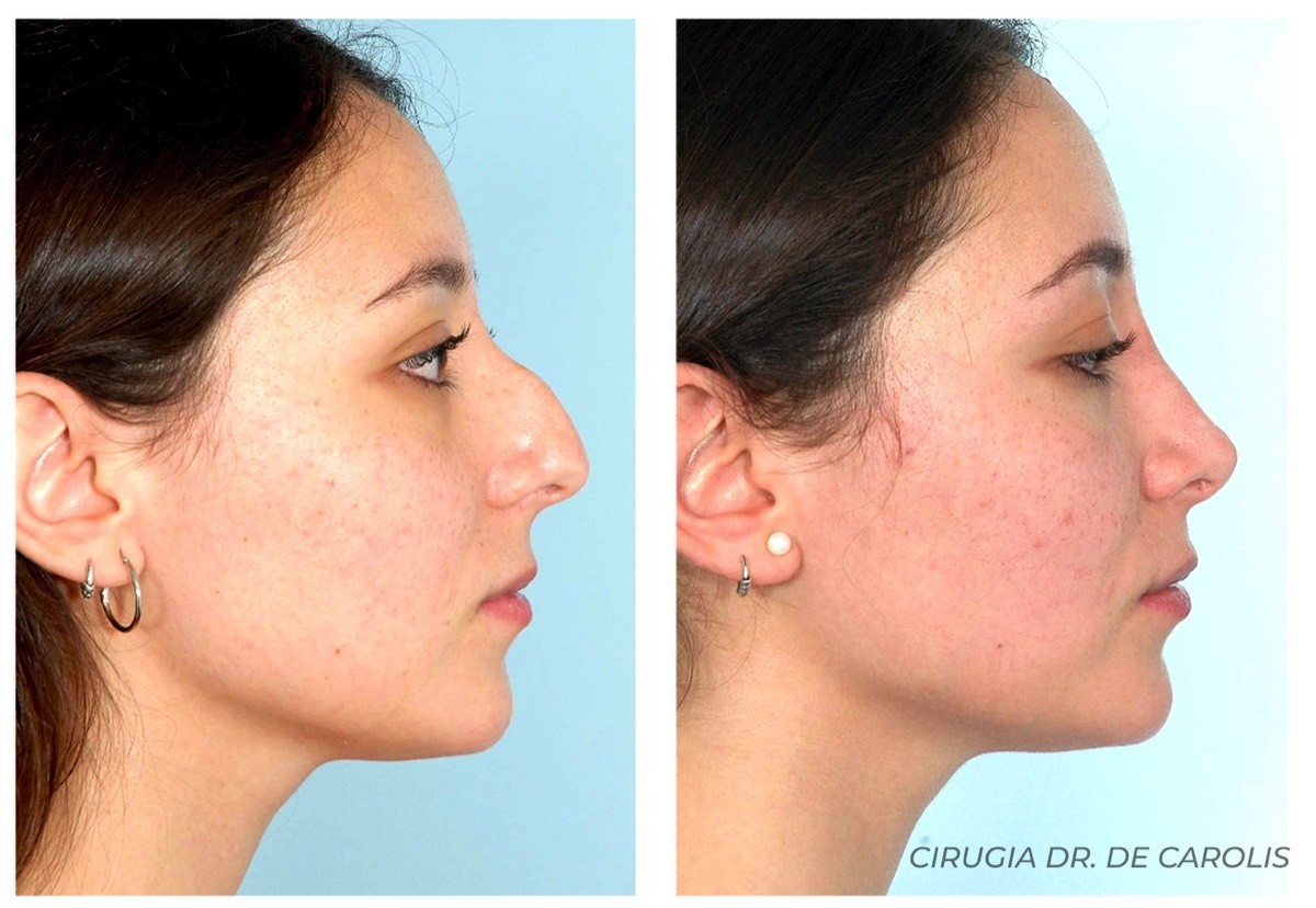 Rinoplastia ultrasónica en paciente con dorso nasal prominente realizada por el Dr. Vicente De Carolis. Perfil.