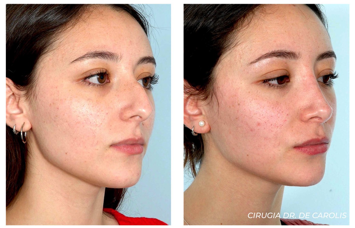 Rinoplastia ultrasónica en paciente con dorso nasal prominente realizada por el Dr. Vicente De Carolis. Semiperfil