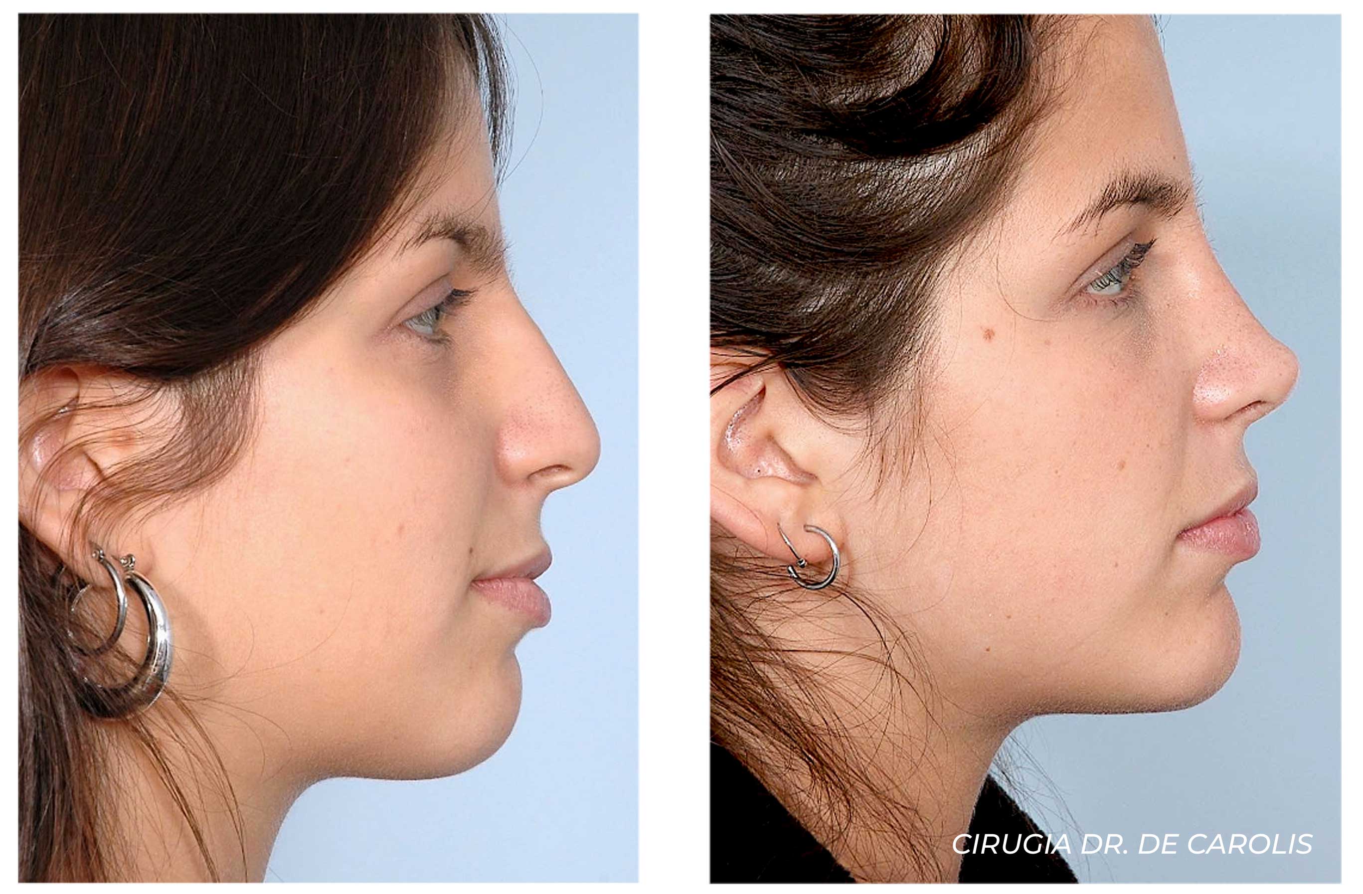  imagen-rinoplastia-cirugia-de-nariz