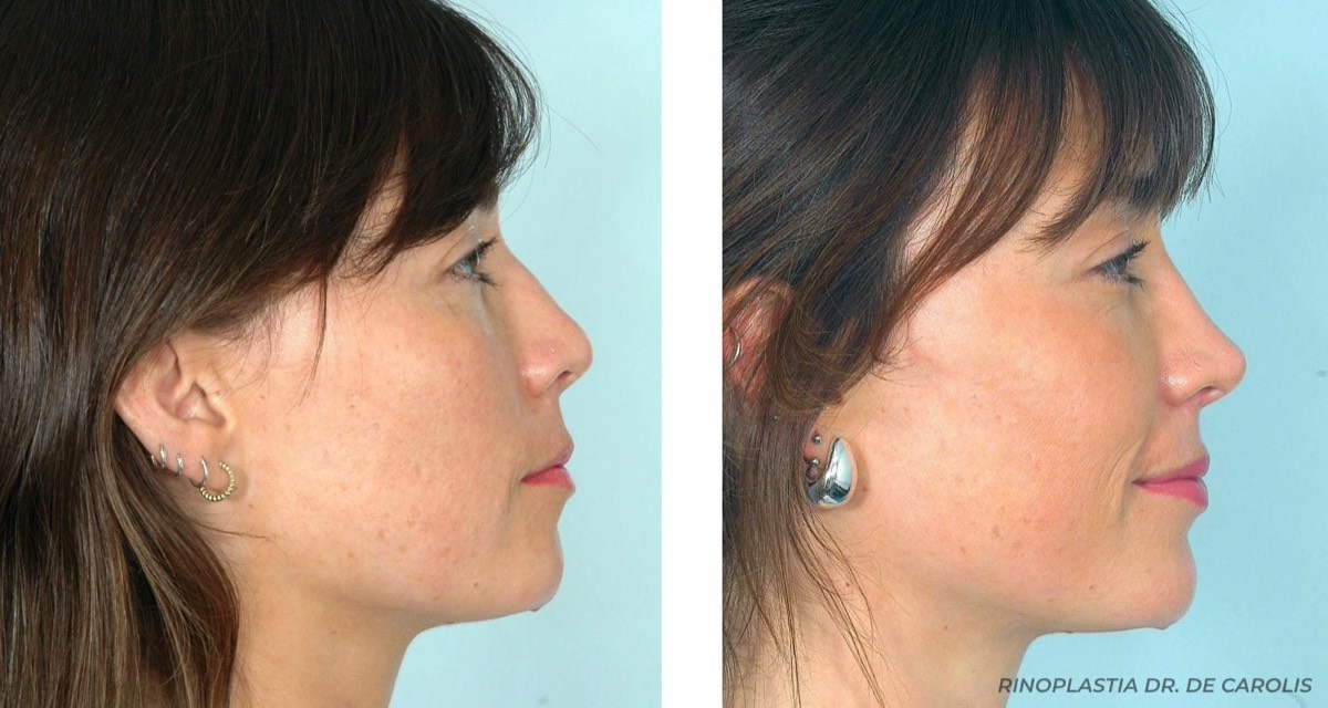 Rinoplastia terciaria con resultado extraordinario por el Dr. De Carolis. Vista de perfil.